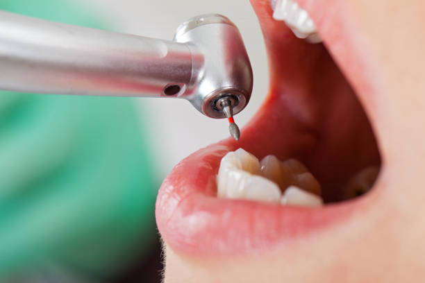 Best Emergency Wisdom Teeth Removal in Morgantown, KY